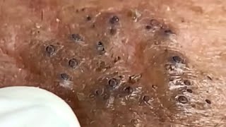 Blackheads & Whiteheads Satisfying Removal Acne and Pimple @0789