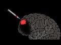 Neurosurgery and Brain Repair