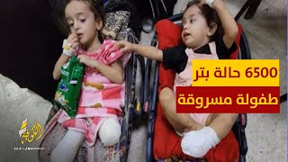 6500 حالة بتر منذ بدء حرب الإبادة.. طفولة مسروقة وشباب منقوص
