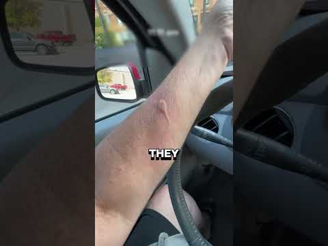 BEE STING ?