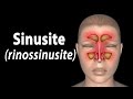 Sinusite: Causas e Sintomas