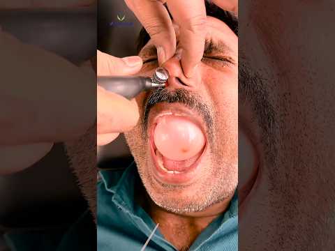 CFR for Facial Pain #chiropractor #cor #reelsvideo #reelsviral #migraine #virals #shorts