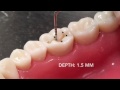 Dental Procedures and Amalgam Techniques