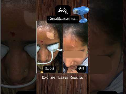 Vitiligo can be treated with focused Excimer Laser Therapy. #vitíligo #ತನ್ನು #laser #excimer #reults