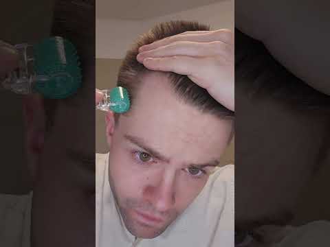 How I use Minoxidil and the Derma Roller for Hair RESTORATION