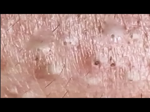 Blackheads & Whiteheads Satisfying Removal @0341