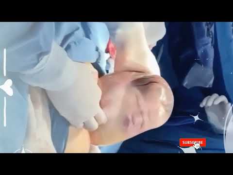 Incredible moment baby is born with amniotic sac #babyborn #baby #viral