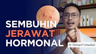 Ini Cara Sembuhin Jerawat Hormonal - Dokter Richard