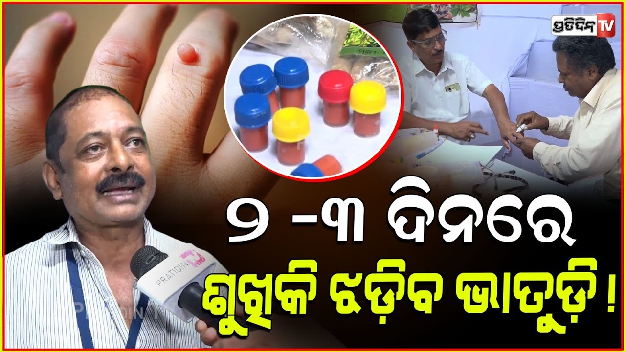 ଶୁଖିକି ଝଡିଯିବ ଭାତୁଡ଼ି, ଔଷଧ ଦାମ୍ ମାତ୍ର ୧୦୦ ଟଙ୍କା। Ayurvedic ointment for warts, Kalinga Herbal Mela.