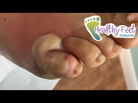 SUPER INFECTED WART POPPED