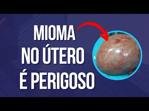 MIOMA no útero é PERIGOSO?