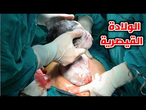 شاهد عملية الولادة القيصرية خطوة بخطوة_step by step cesarean section procedure