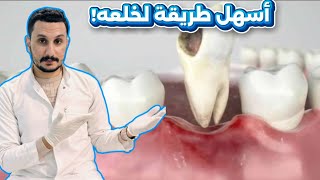 خلع جذور الأسنان بكل بساطة! (خطوة بخطوة بدون تعقيد)