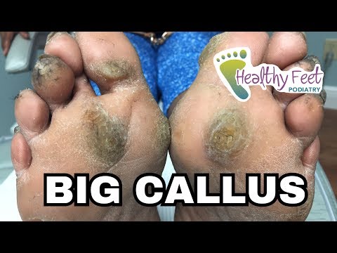 BIG Calluses on Both Feet