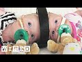 Innovations in Conjoined Twin Surgery