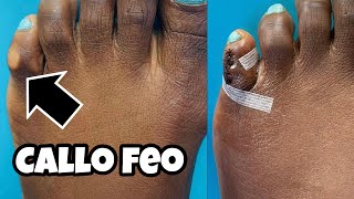 CIRUGIA MINIMAMENTE INVASIVA DE DEDOS DE MARTILLO Y EXCISION DE CALLOS FEOS DEL PIE