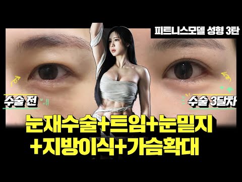 피트니스 모델 성형 3탄 | 성형 3달차! 매몰눈재수술+뒤밑트임+눈밑지+지방이식+가슴확대 #성형모델 #성형전후 #성형브이로그