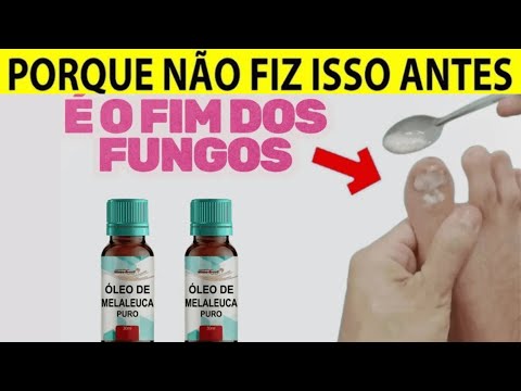 👣5 GOTAS 2x AO DIA COM ESTE ÓLEO QUE ELIMINA OS FUNGOS DAS UNHAS EM 30 DIAS