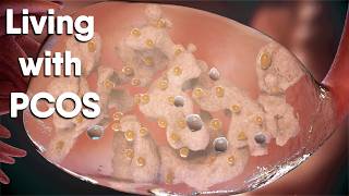 PCOS: Why It Happens and What You Can Do