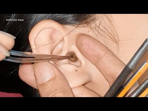 Ear picking | Lots of ear wax sealed ears