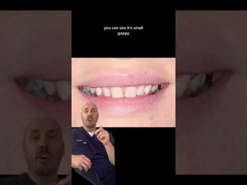 Person discussing dental gaps and smile appearance.