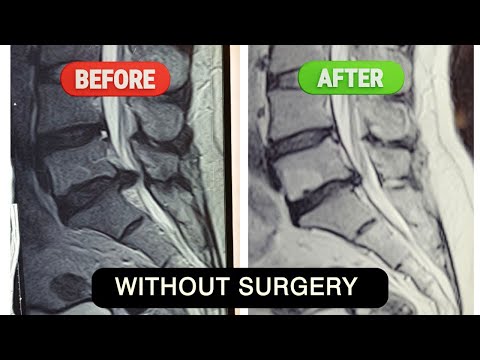 स्लिप डिस्क कैसे ठीक करे | स्लिप डिस्क को वापिस जगह पर कैसे लाएं | L4-L5 L5-S1 disc herniation