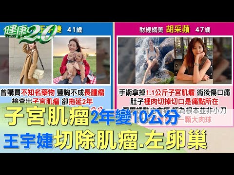 子宮肌瘤2年變10公分 王宇婕切除肌瘤.左卵巢 健康2.0