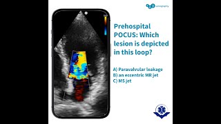 Which lesion is depicted in this loop?