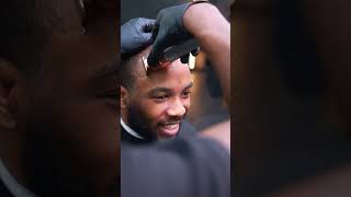 Day 34 after My hair Transplant