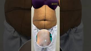 Tummy Tuck | Tummy Tuck Result