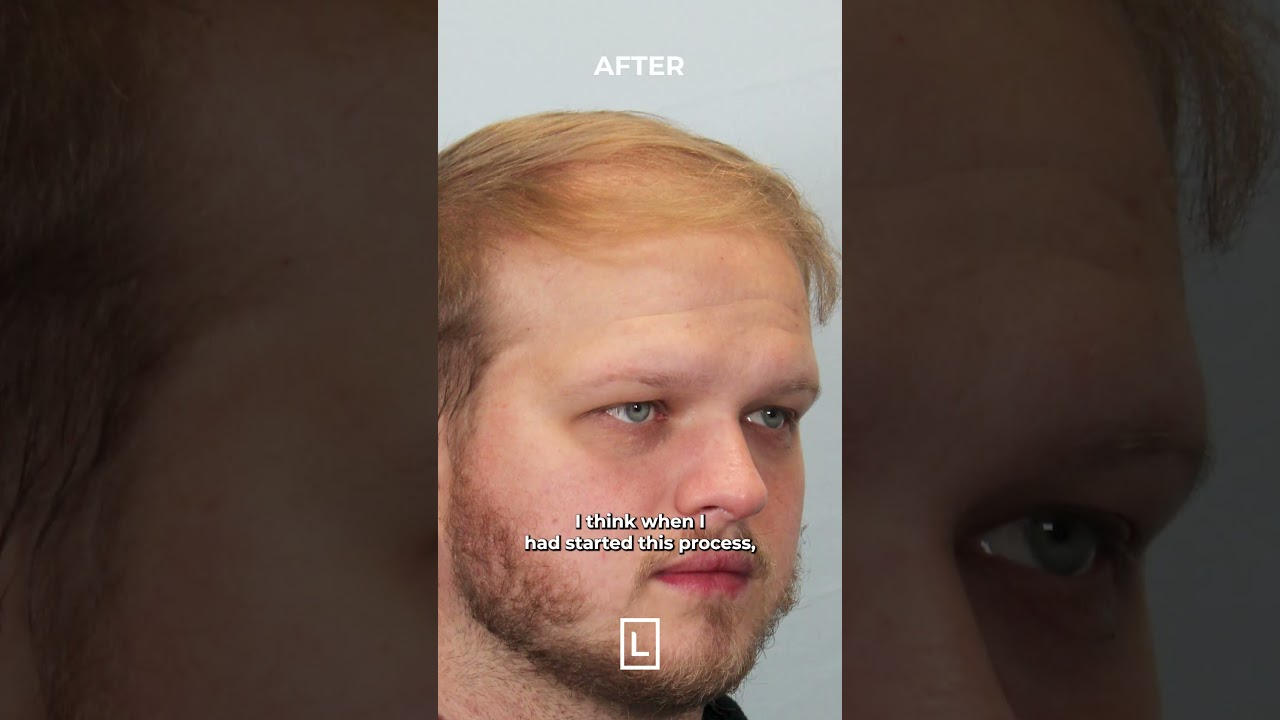 Hair Transplant video