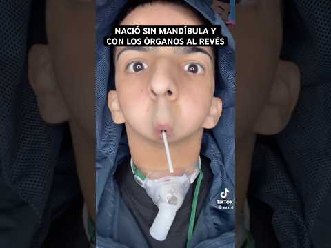 Nació sin MANDÍBULA y con los ÓRGANOS al revés - Agenesia mandibular y SITUS INVERSUS totalis