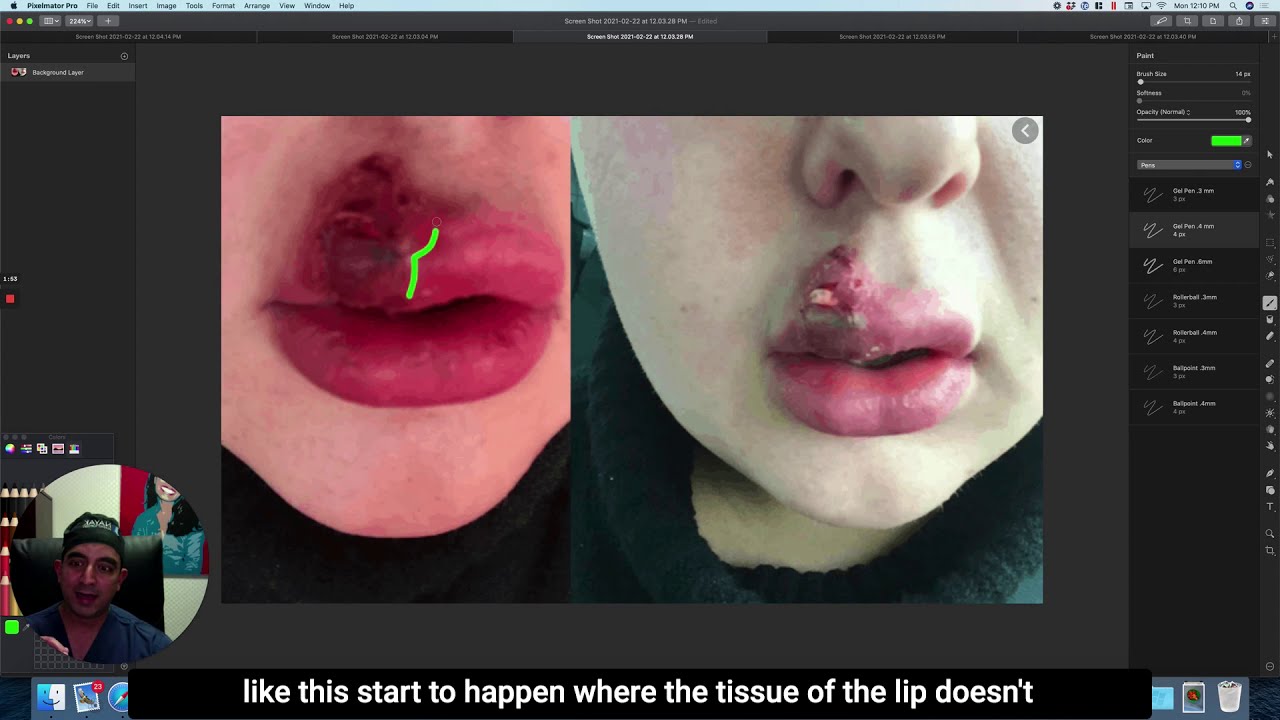 Lip injury before and after treatment comparison.