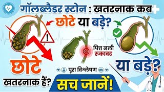 गॉलब्लडर की पथरी: छोटे या बड़े? कौनसा है ज़्यादा खतरनाक? (पूरा विश्लेषण)
