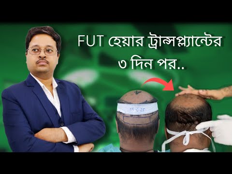 FUT হেয়ার ট্রান্সপ্ল্যান্টের ৩ দিন পর | ডা. জয়ন্ত বাইন | Plastic Surgeon Kolkata