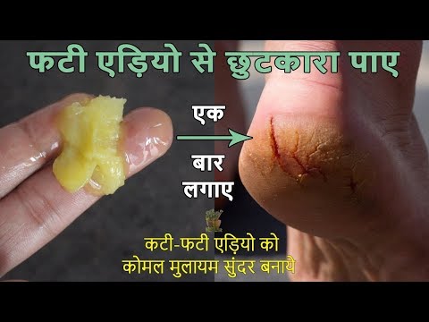 फटी एड़ियो से छुटकारा पाने का अचूक उपाय-Cracked Heels Home Remedy / Cracked Heels Treatment