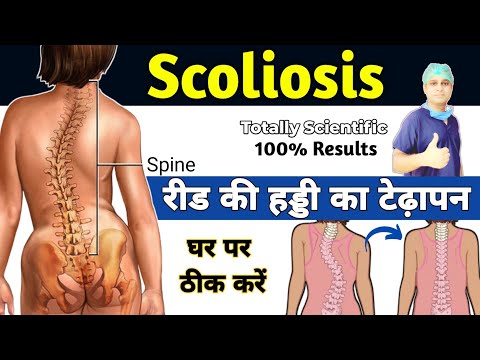 ✅Best Exercises For Scoliosis in Hindi | कमर का टेड़ापन कैसे ठीक करें | Scoliosis Treatment at Home