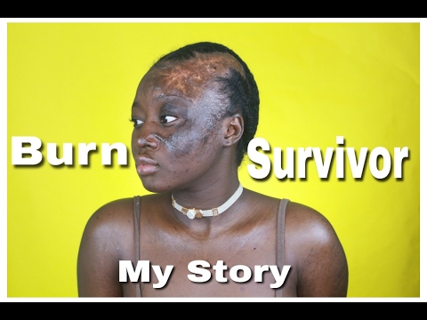 I Am A Burn Survivor & Beautiful | Dear Shalom
