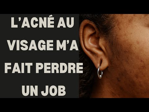 L’ACNÉ AU VISAGE M’A FAIT PERDRE UN JOB
