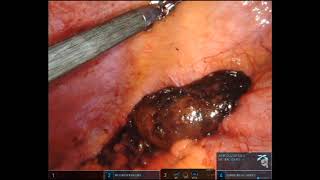 Colonoscopic Assisted Robotic Resection (CARR) of Giant Colonic Lipoma