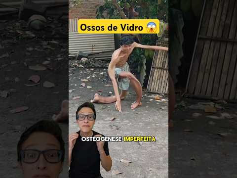 Ossos de Vidro 😱#medicina #medico #enfermagem #enfermeiro #enfermeira Osteogênese Imperfeita Cristal