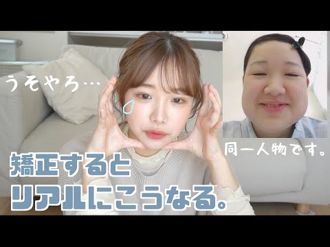 【矯正の金額は？】口元がキモいと言われる理由をお話します。
