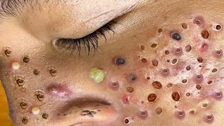 Loan Nguyen Acne Treatment 133c