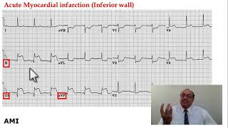 #internal_medicine #cme #usmle #محاضرات_باطنة #ecg #كورسات_باطنة #clinical #clinical #medicine