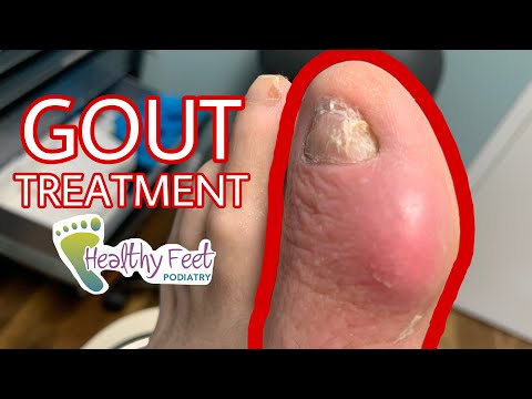 HOW TO TREAT A VERY BAD GOUT ATTACK