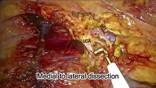 Laparoscopic Abdomino Perineal Resection | Step by step approach | Rectal Cancer Surgery