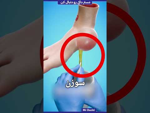 هیچ وقت تاول رو نترکون! 😱