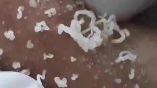Pimple popping | Cyst popping | Прыщи | Акне | Pimple | Blackhead | Cyst | Черные точки