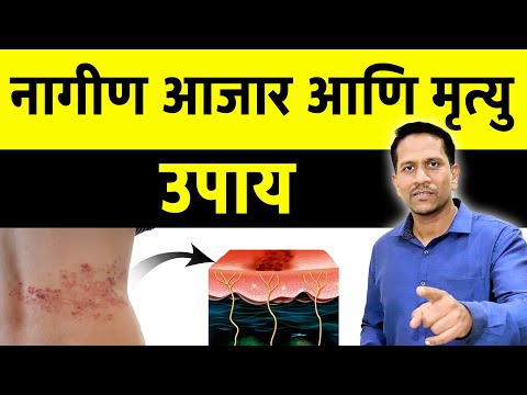 नागीण आजरा आणि मृत्यू? Herpes zoster virus treatment | Dr Nagarekar |