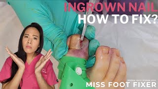 How to Fix an Ingrown Nail | Treatment Explained